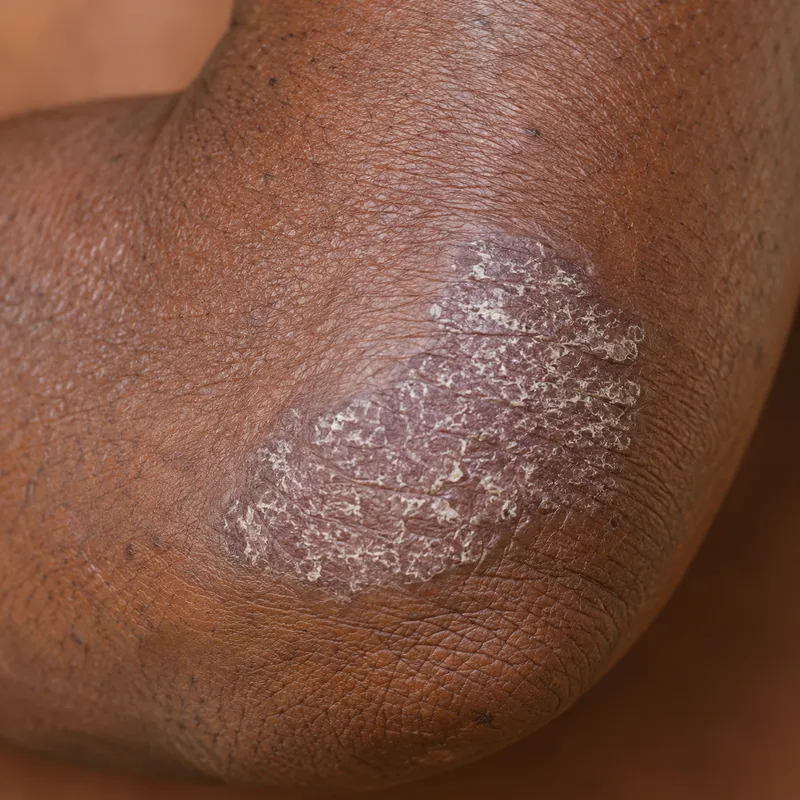 Illustration : Psoriasis